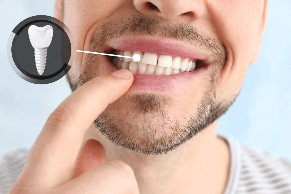 How teeth looks after Dental Implants
