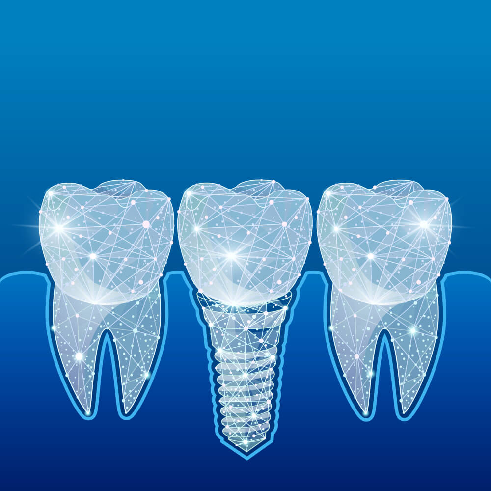 Dental Implants’ Effect on Your Oral Health