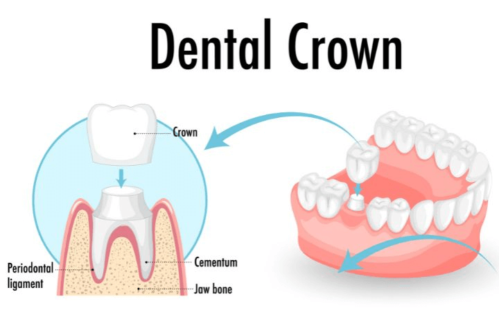 The Crown Placement Process