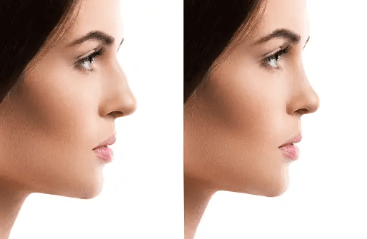 The Top Five Nose Reshaping Surgery Benefits