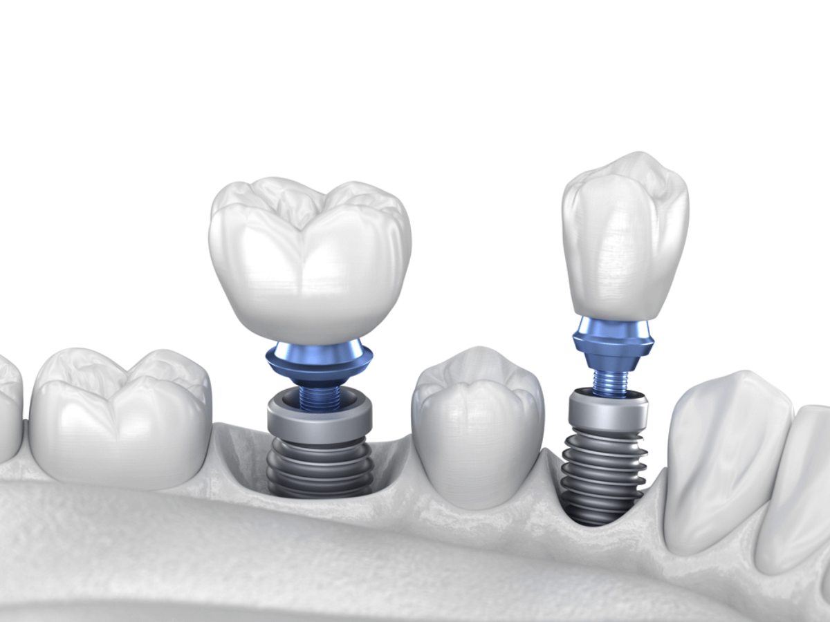 dental implants placement structure