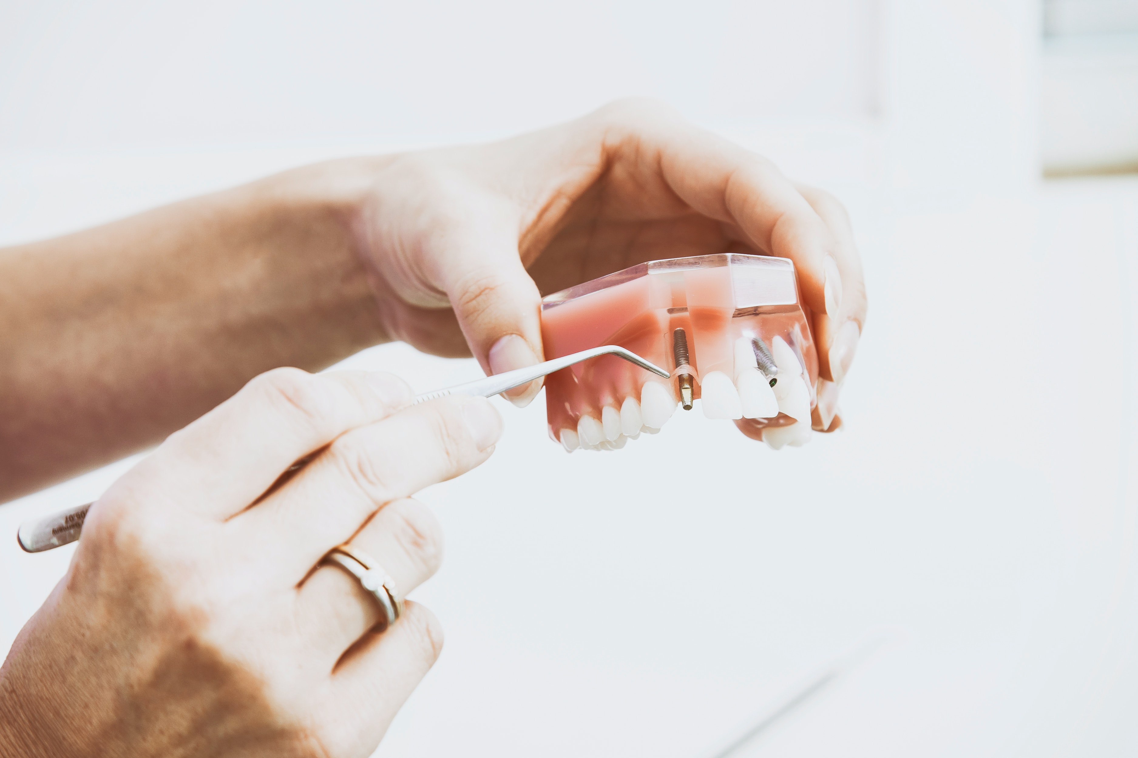 Dental Implants in India: Types, Benefits, Cost
