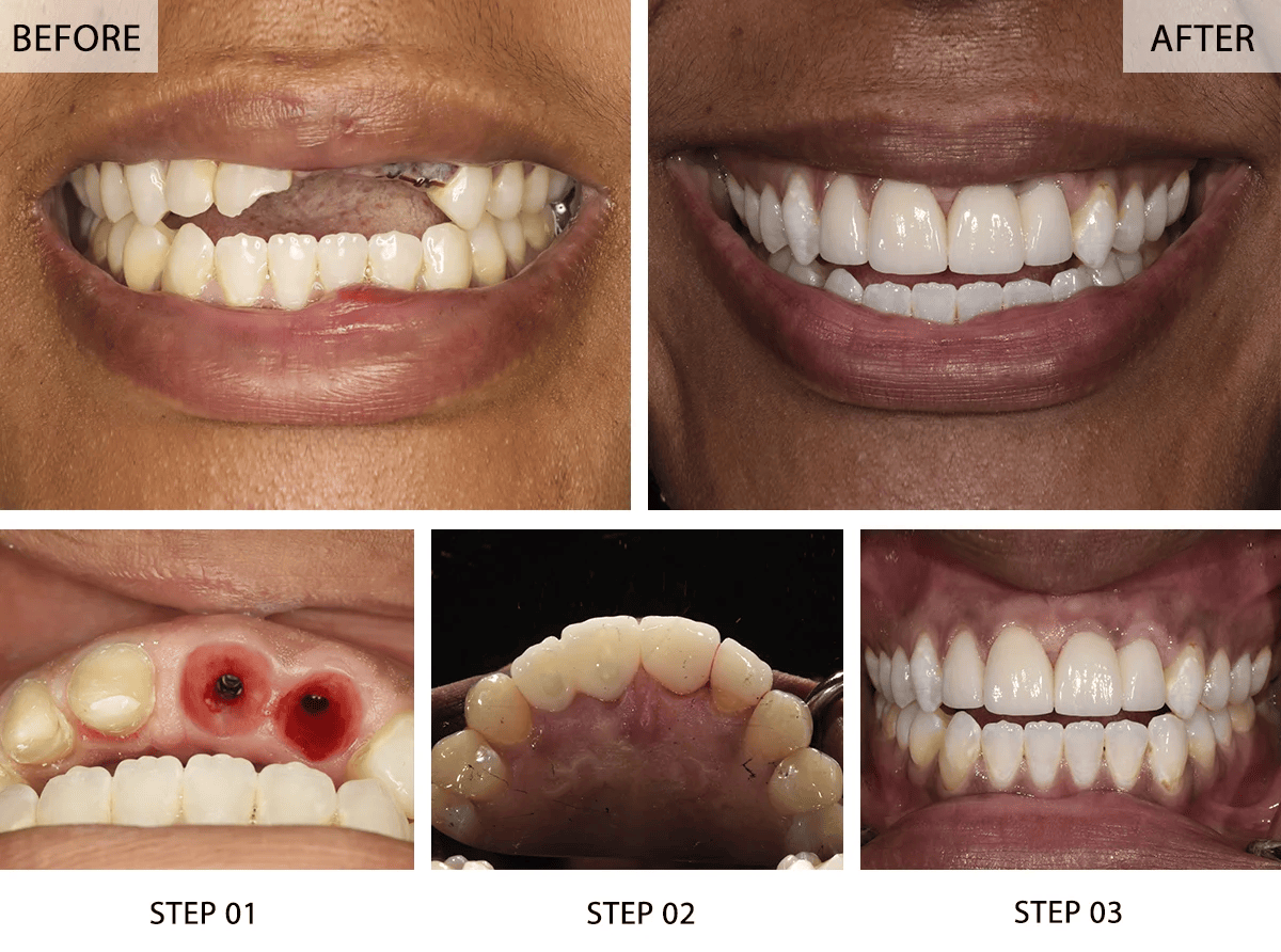 What Makes Denture Implants the Preferred Choice for Missing Teeth