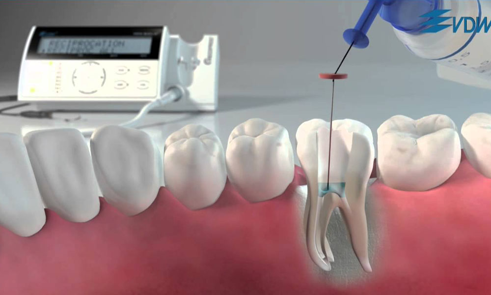 Importance of Root Canal Treatment