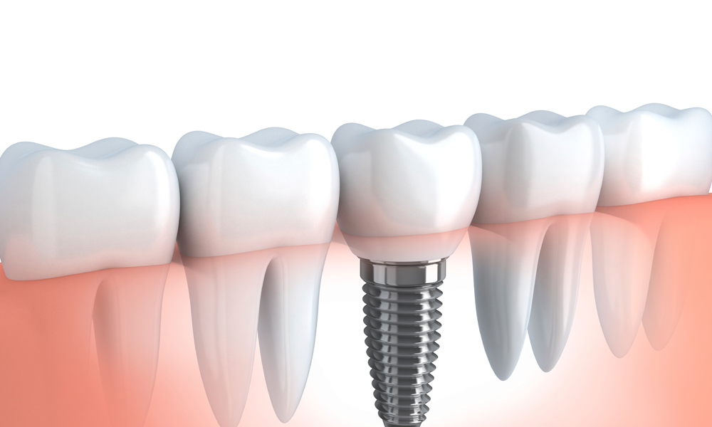 Need Same Day Dental Implant: Understand The Basics