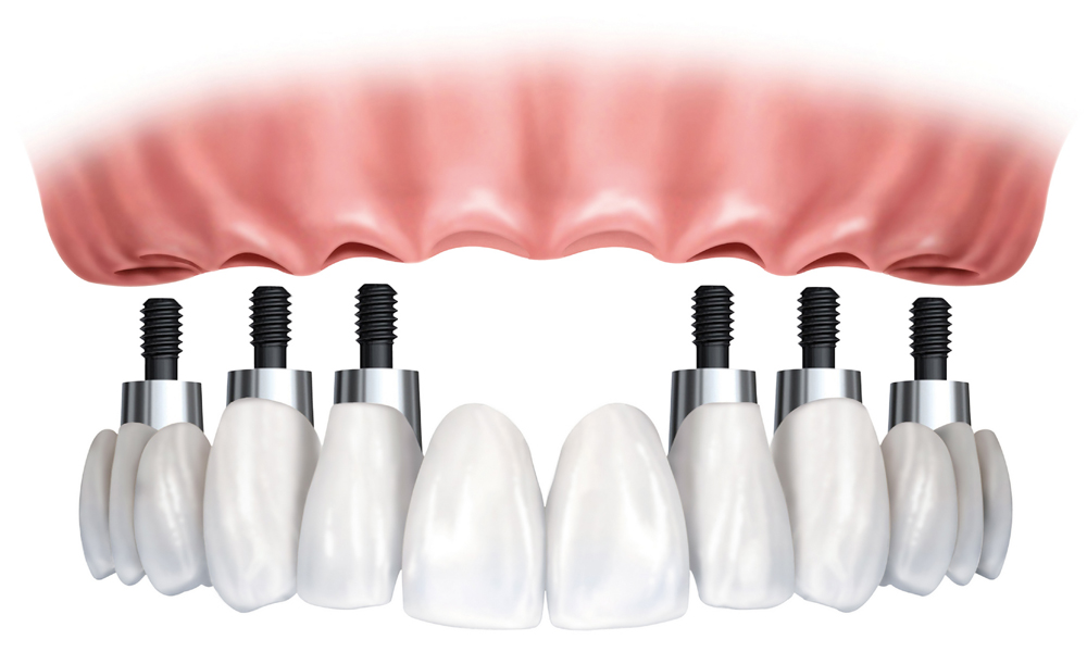 Know About The Dental Implant Treatment