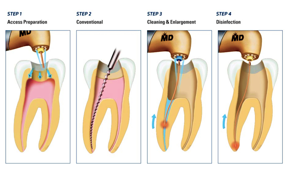 Know Much About the Endodontic Treatment of Malvern?