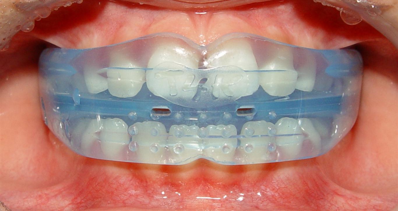 Myobrace: A New and Holistic Way of Treating Dental Problem