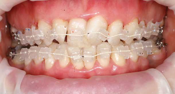 Tooth Alignment: With Advancement you can Get it Done at any Age
