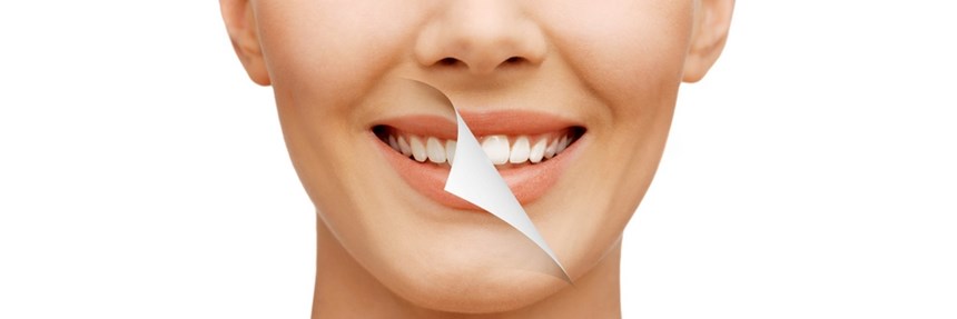 Teeth Whitening Tactics: Choosing Right Way to Whiten Your Smile in Melbourne