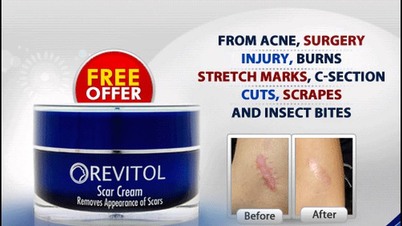 Acne Cream Scar Removal and Treatment