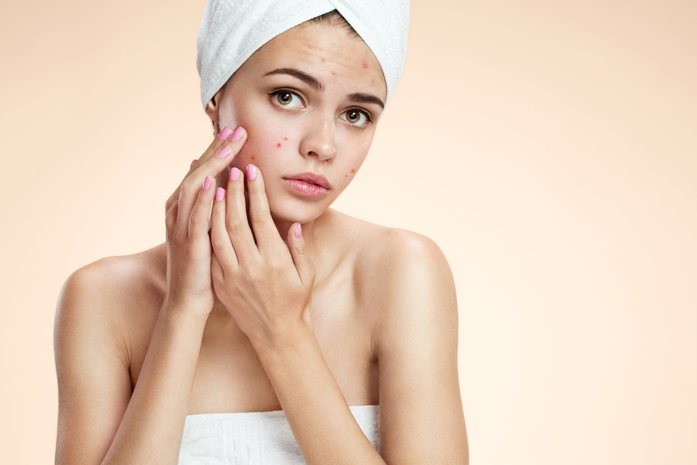 Understanding the Life Cycle of acne and How to Get Rid of it