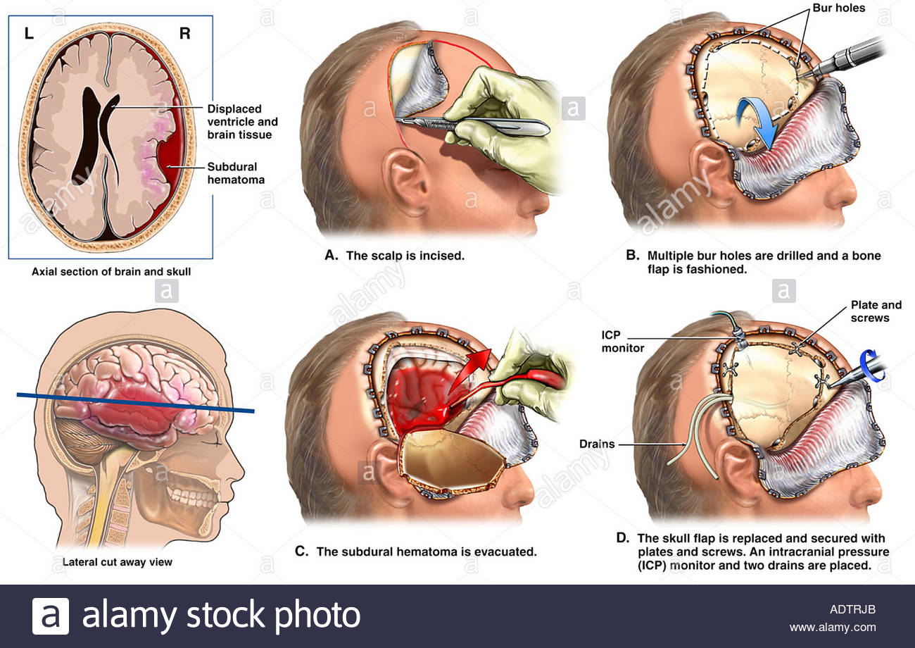 All About Craniotomy Surgery