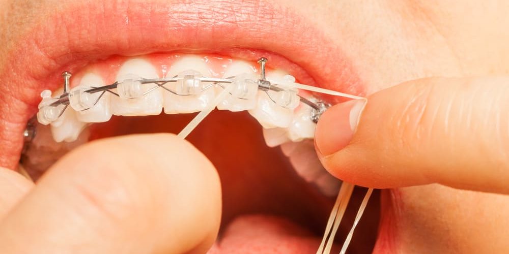 Why you must choose Orthodontists in Melbourne to restore your lost smile