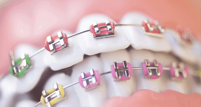 Why Orthodontics Treatment Is Good for Your Dental Health?