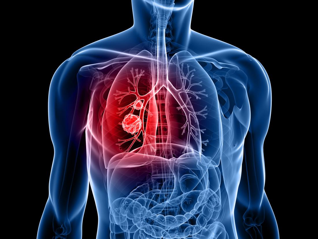 Lung Cancer Patient Must Read for Better Treatment