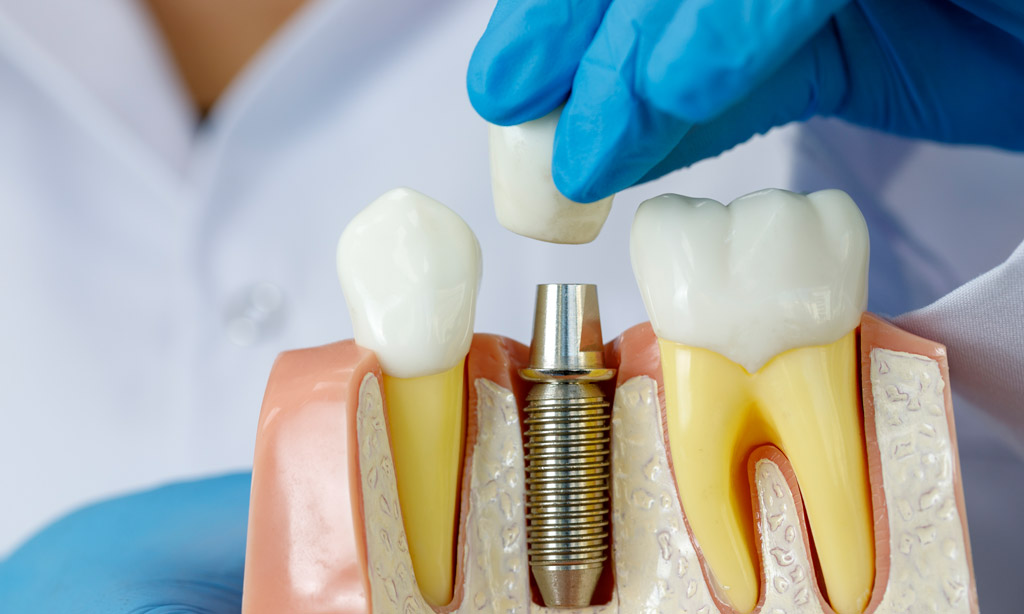 Visit A Top Dental Clinic Melbourne For Wisdom Tooth Removal