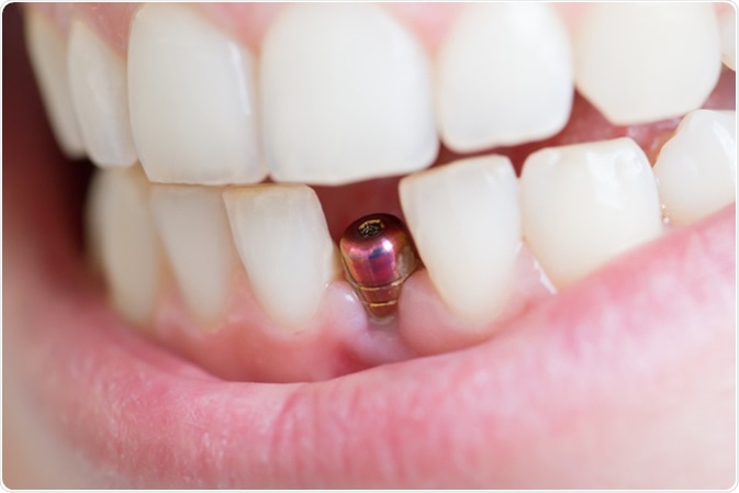 How Strong Are Dental Implants?