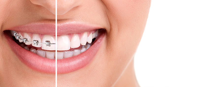 How To Win With The Right Orthodontics Expert In Brunswick, Melbourne?