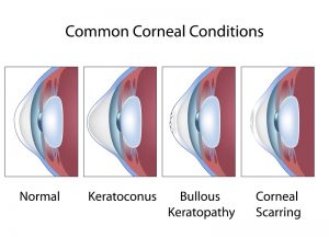 Orthokeratology