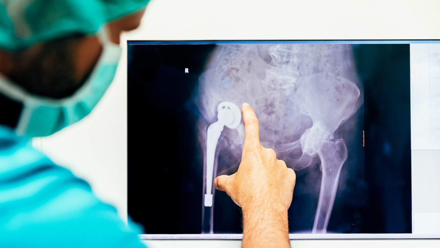 Is Hip Replacement a Good Option For Hip Fractures?