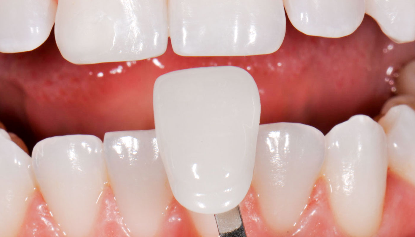 Things people want to know before opting for porcelain veneers Melbourne professional Services