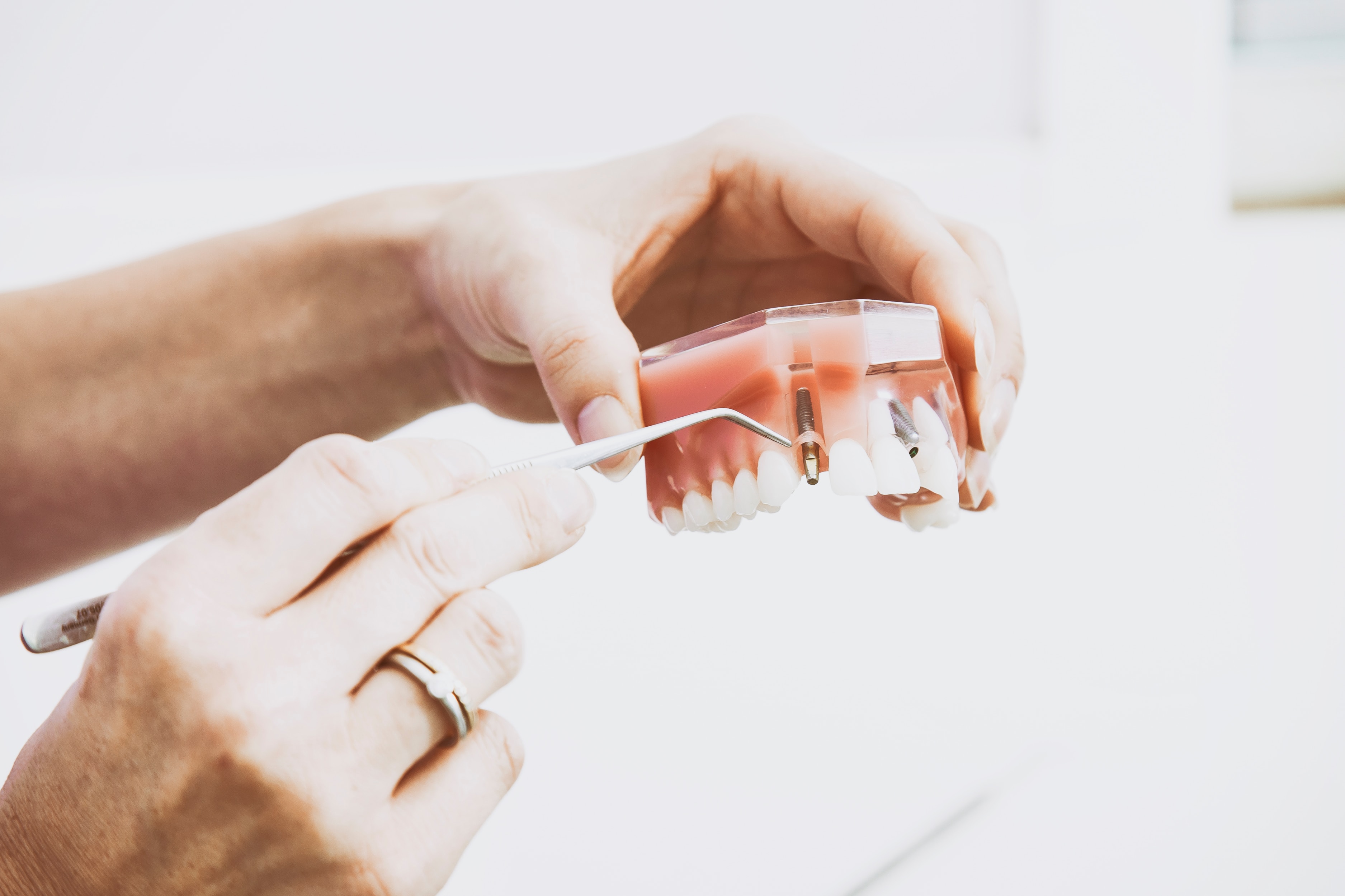 5 Important Questions About Dental Implants
