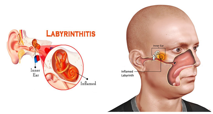 What Is Labyrinthitis? – Causes, Symptoms, And Treatment