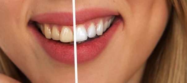 9 Things Dentists Wish You Knew About Teeth Whitening