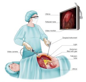 laparoscopic surgery