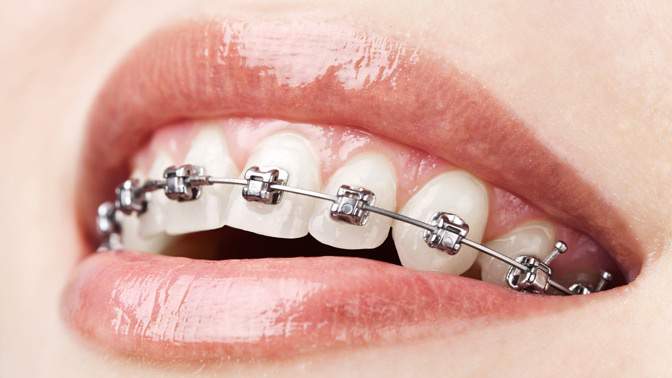 Teeth Alignment Treatments