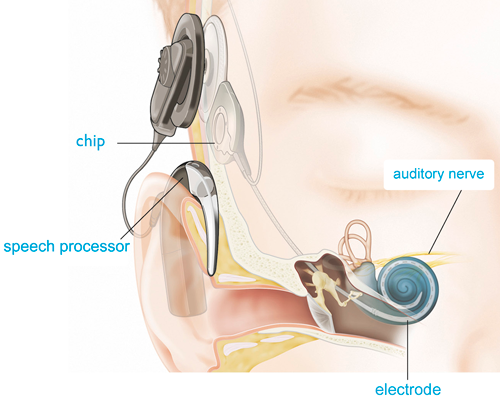 What are Digital Hearing Aids?