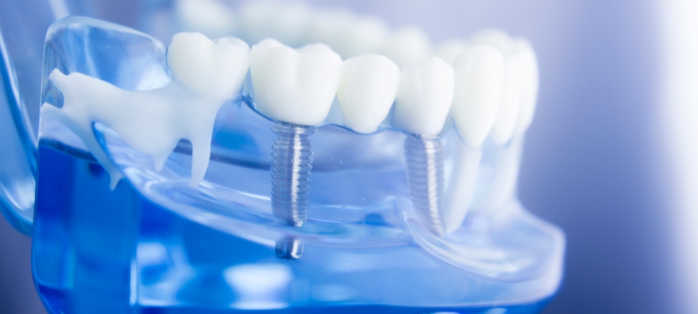Why Dental Implants Are Important and How It Works or Done?