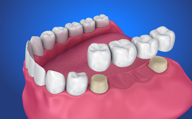 Get to Know The Different Types of Dental Crowns and Dental Crown Design