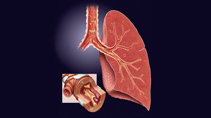 How Can You Treat Chronic Bronchitis If You Suffer From It?