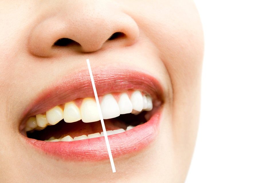 Teeth Whitening: Why You Should Go For It and Why Not?