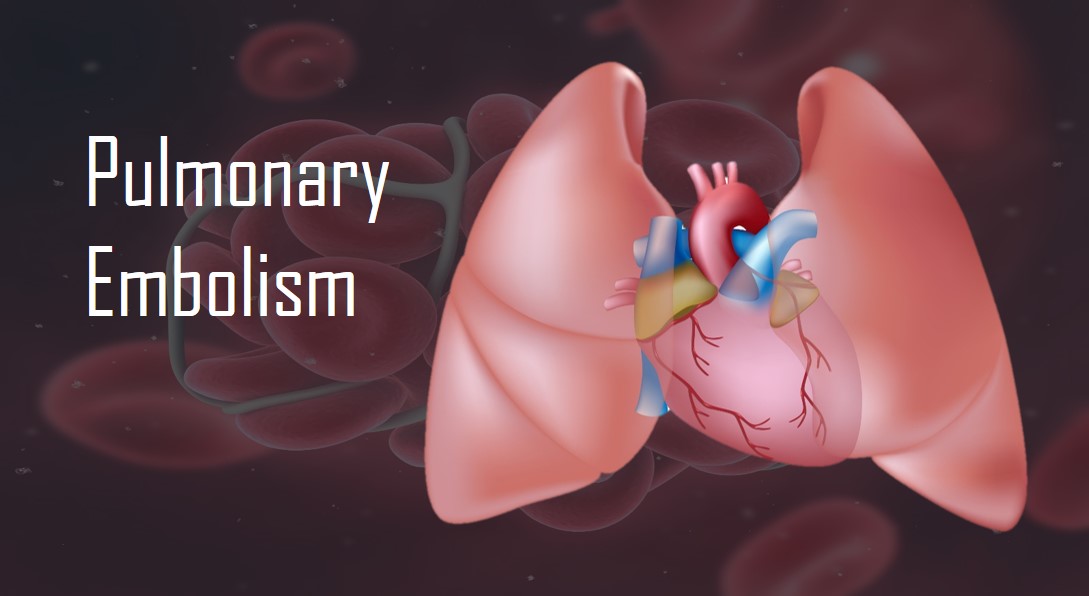 Can You Survive A Pulmonary Embolism?