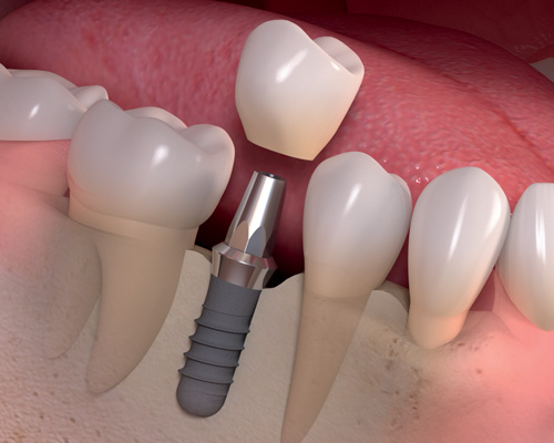To Have Sparkling Smile Prefer Dental Implants in Flemington