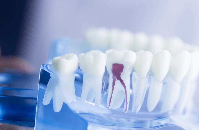 Get Root Canal Melbourne Professional Services to Save Infected Teeth