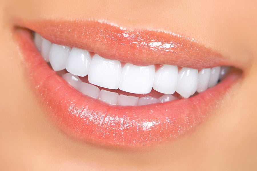 How to Find the Best Dental Clinic for the Procedure of Porcelain Veneers in Auckland?