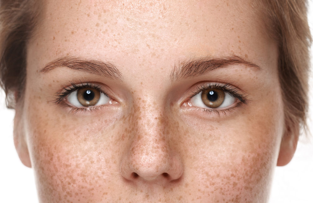 Pigmentation Removal Singapore – Types and Treatment Options