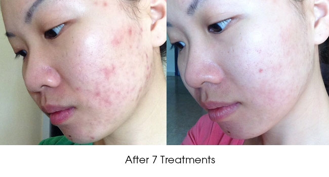 Acne Scar Removal in Singapore: What Options Do You Have
