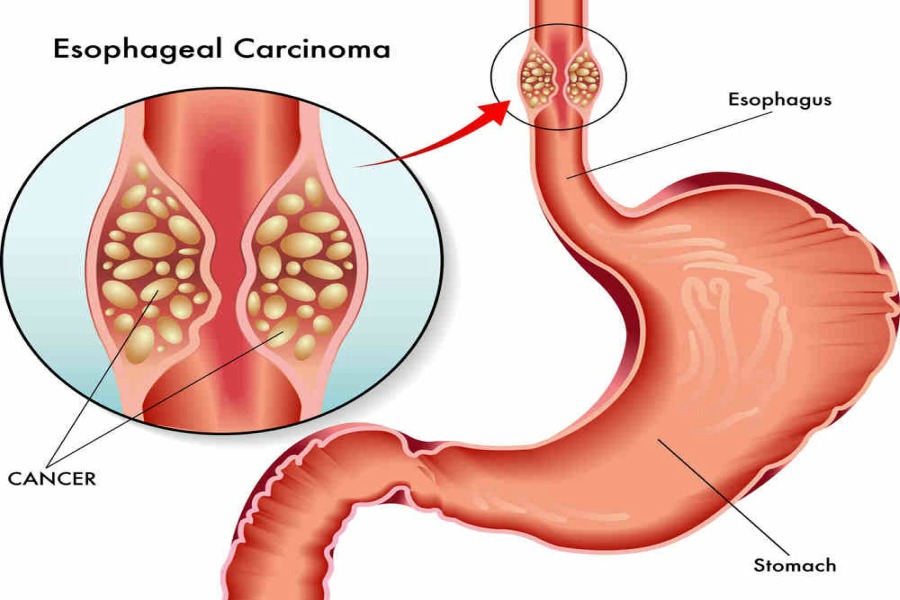 Surgery For Cancer Of Esophag(Foodpipe)