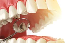 How to Fight Cavities And Prevent Tooth Decay?