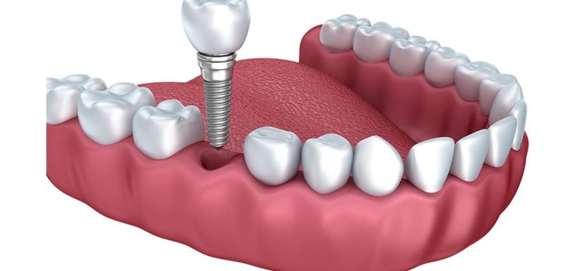 6 Important Facts About Dental Implants