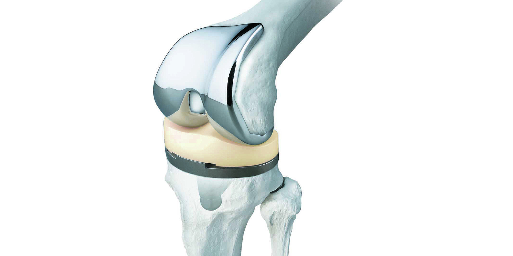 Why Choose The Best Orthopaedic Implants Manufacturers For Your Joint Needs?