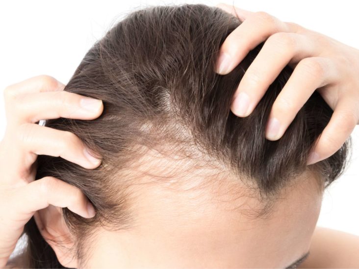 How Long Does PRP Last for Hair Loss?