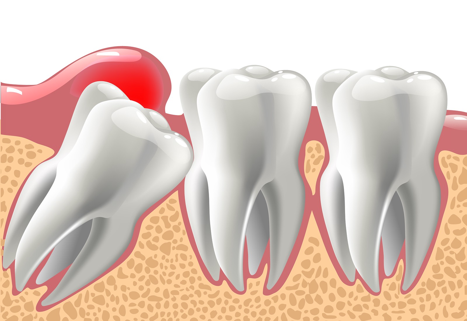 Potential Benefits of Wisdom Tooth Extraction For Better Living