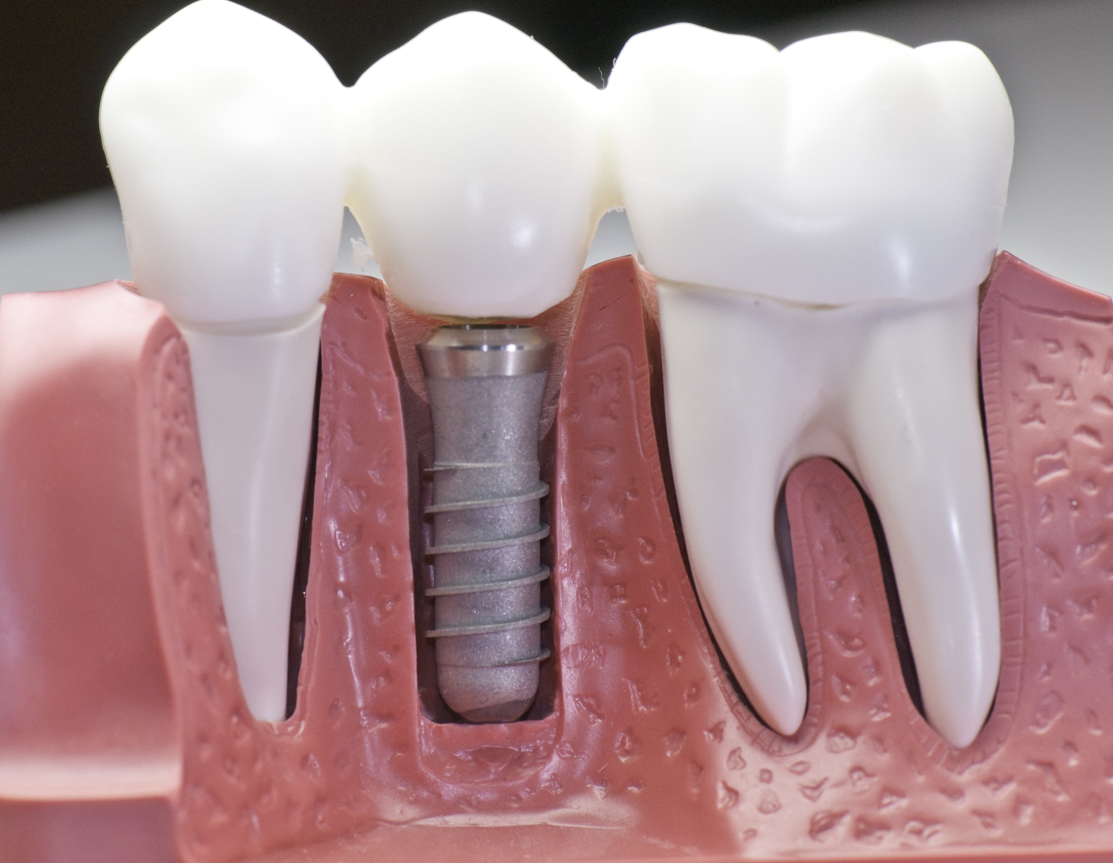 Dental Implants Treatment Experts Share Vital Information About Implant