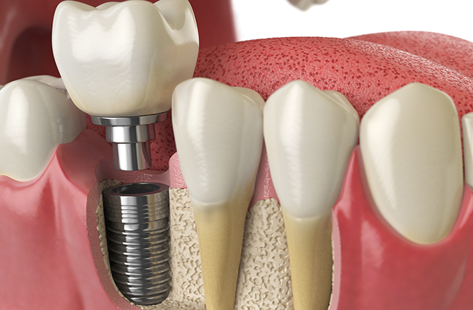 The professionals’ works for Holistic Dental Melbourne CBD that helps patients undergoing dental and other oral issues with dental implant treatment. If you are looking for skilled orthodontist near you this is the right place.